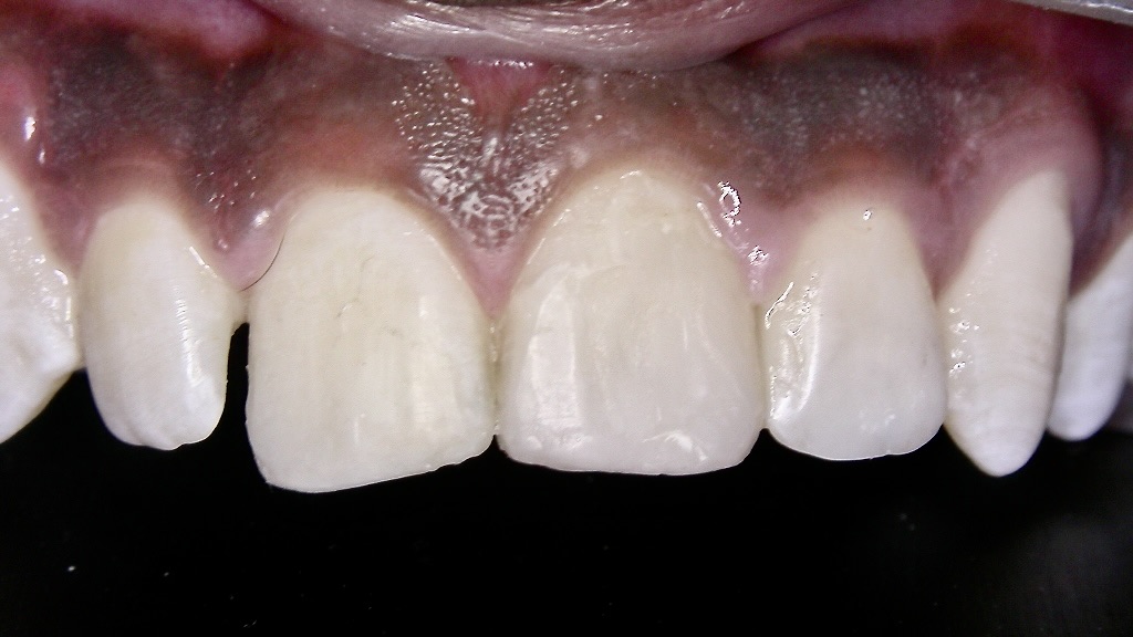 Final restorative outcome